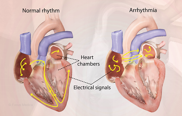 Hypertension & Heart
